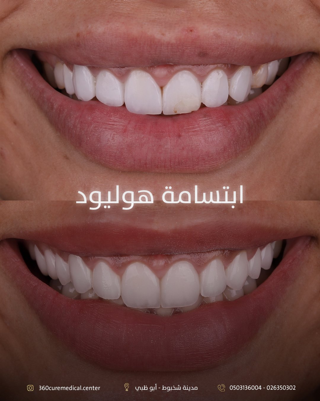 قبل وبعد ابتسامة هوليود في عيادة 360 كيور للاسنان في ابوظبي شخبوط
