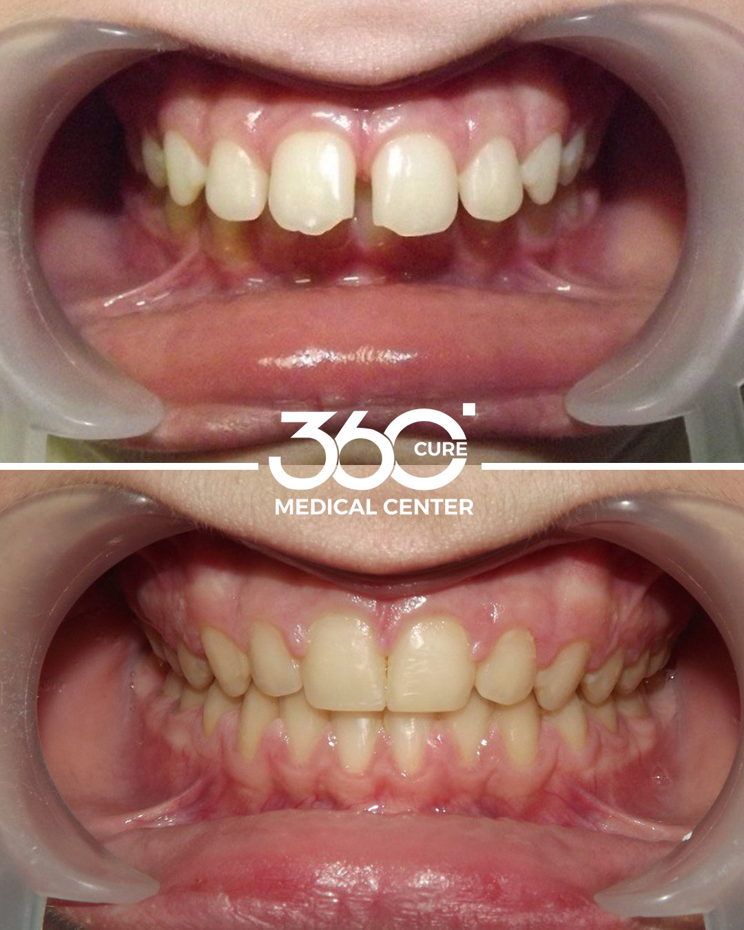 تقويم الاسنان قبل وبعد في عيادة اسنان 360 كيور في شخبوط ابوظبي