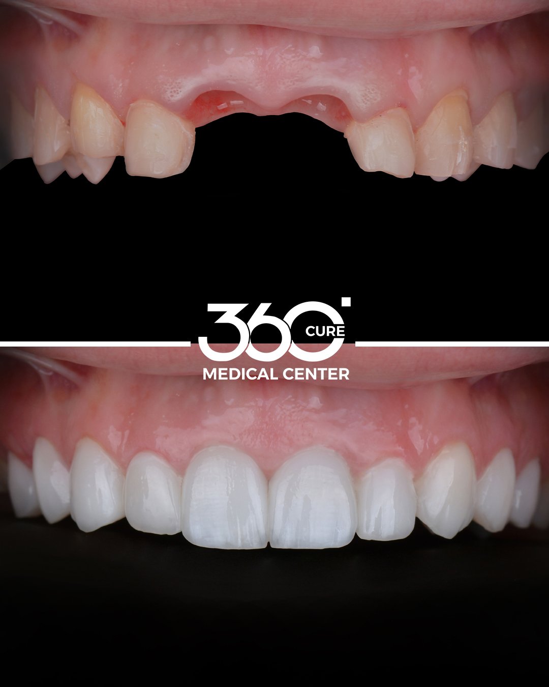 زراعة الاسنان في شخبوط ابوظبي