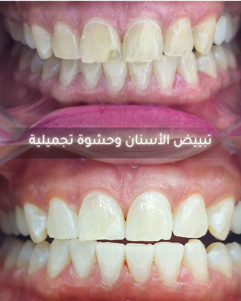 نتائج حقيقية لتبييض الاسنان في ابوظبي بجهاز النانو