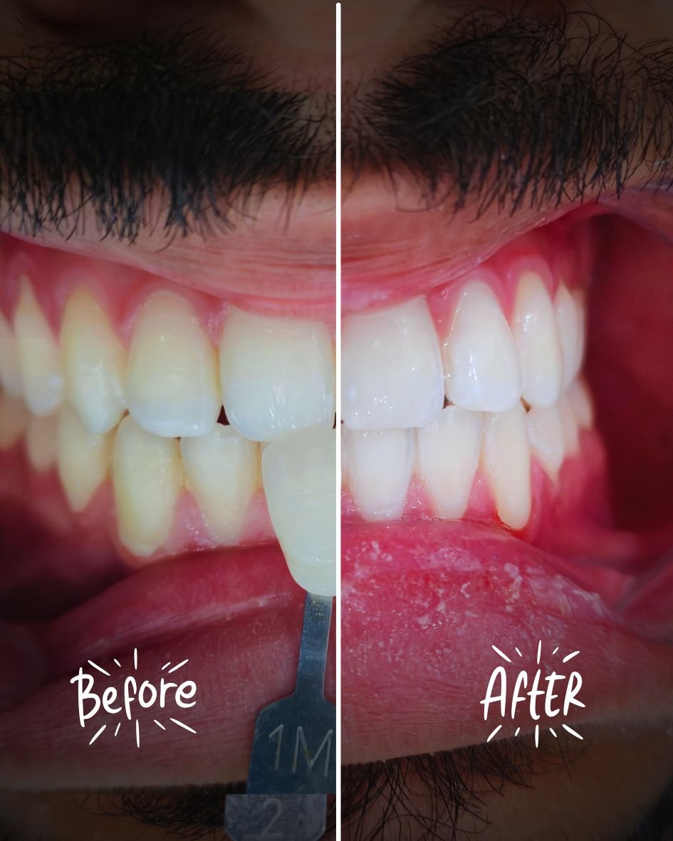 تبييض الاسنان قبل وبعد في ابوظبي teeth whitening nano