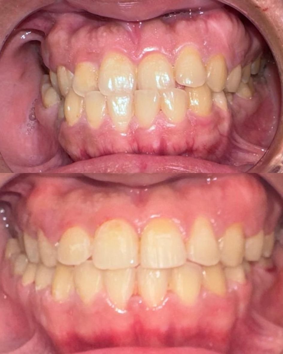 مراحل علاج تقويم الأسنان الوقائي للأطفال والمراهقين في عيادة أبوظبي.