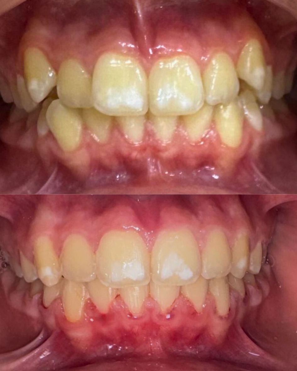 تقويم أسنان معدني تقليدي يُظهر نتائج ممتازة قبل وبعد العلاج في عيادة أبوظبي.