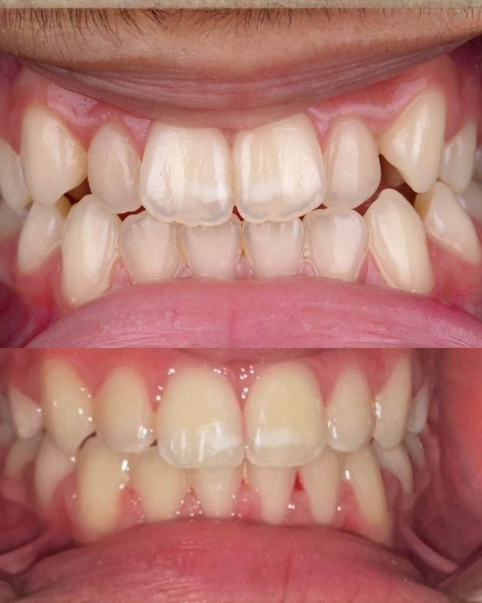 نتائج ابتسامة طبيعية بتقنية (التقويم المعدني) في أبوظبي.