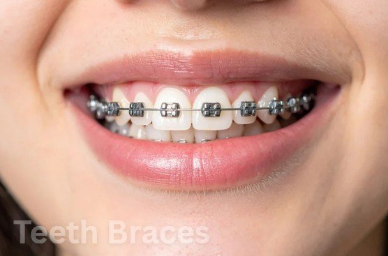 Metal Braces Abu Dhabi