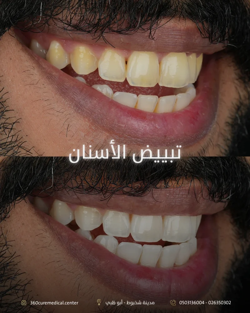 قبل وبعد تبييض الاسنان في ابوظبي شخبوط في عيادة 360 كيور اسنان