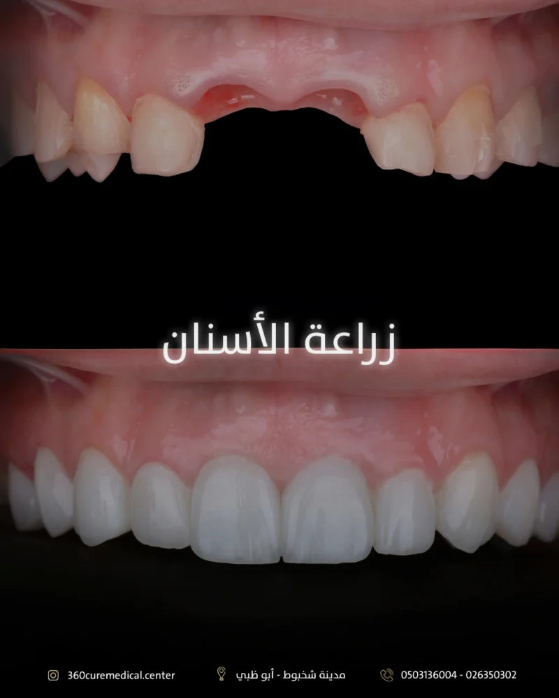 زراعة الاسنان في شخبوط ابوظبي