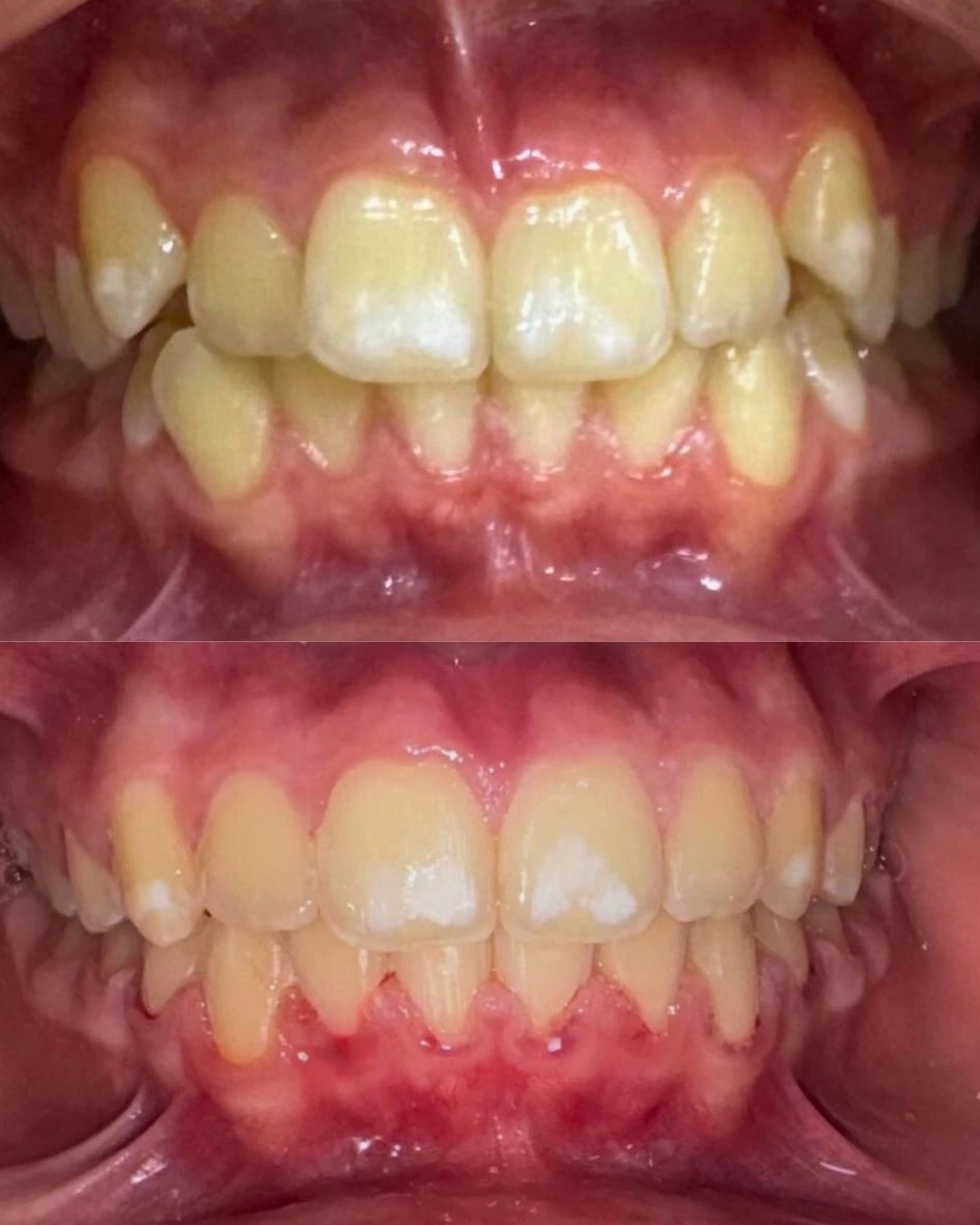 تقويم أسنان معدني تقليدي يُظهر نتائج ممتازة قبل وبعد العلاج في عيادة أبوظبي.