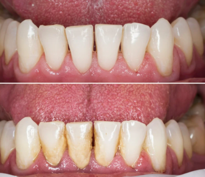 تنظيف الاسنان في ابوظبي شخبوط