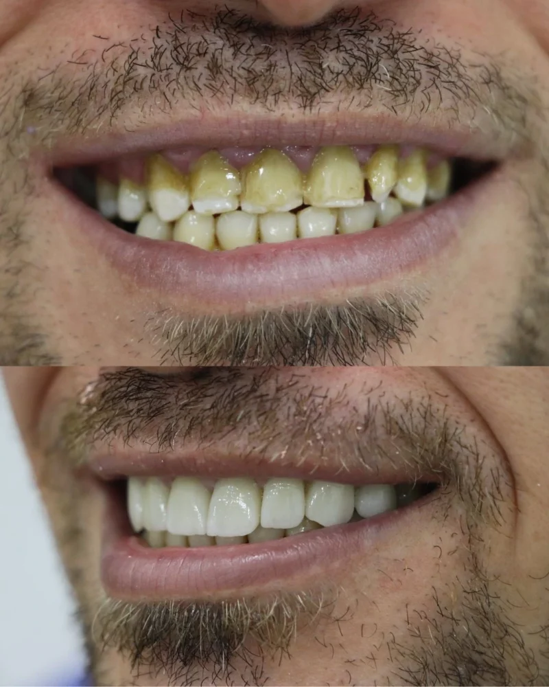 ابتسامة الاسنان بالفينيرز قبل وبعد في ابوظبي الامارات مدينة شخبوط