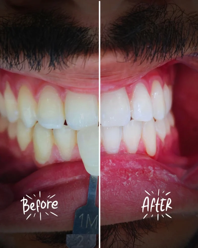 تبييض الاسنان قبل وبعد في ابوظبي teeth whitening nano