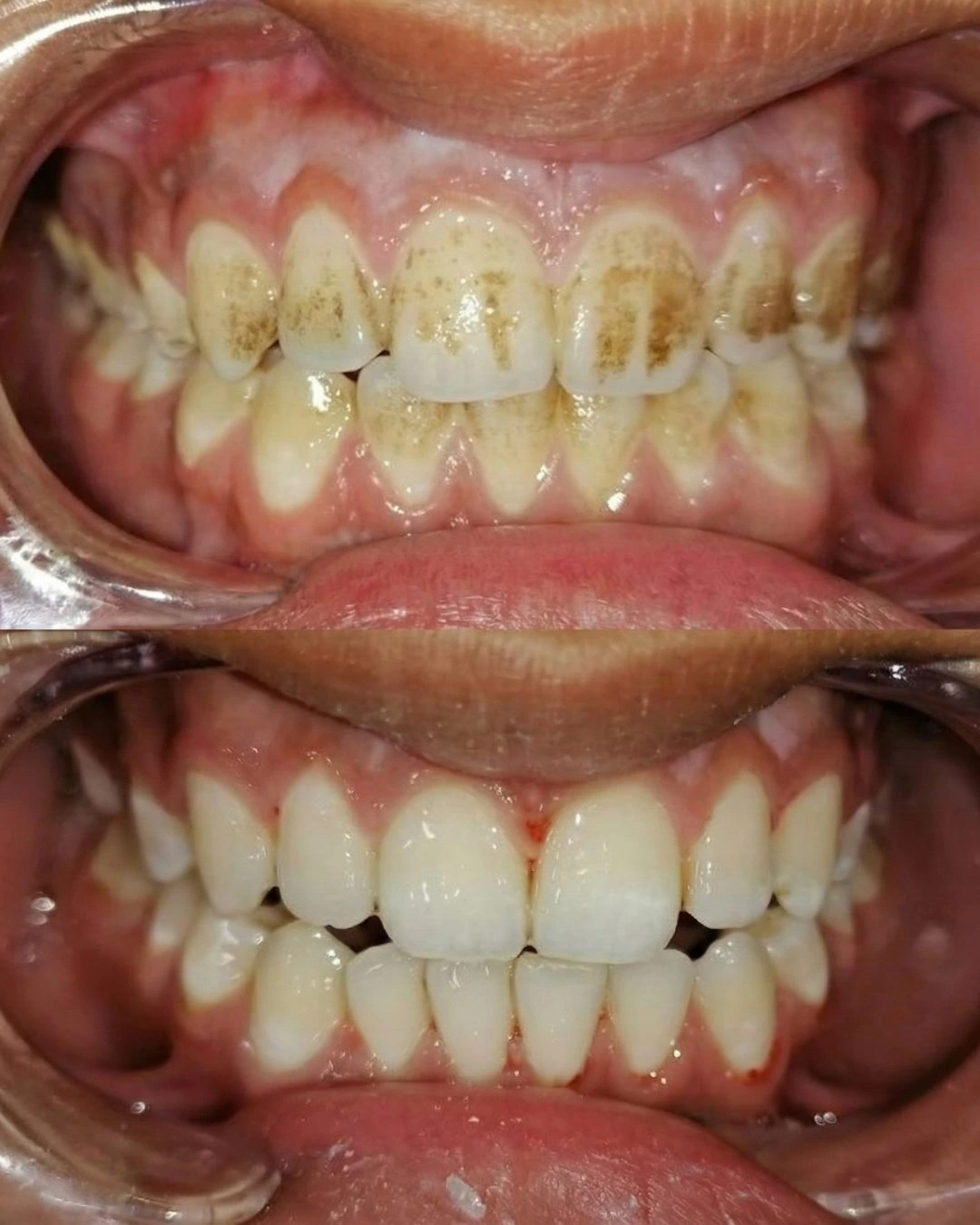 تنظيف اسنان قبل وبعد